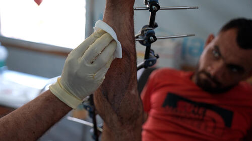 An MSF staff checks the injury of Saad Hussein, who is forced to live with an external fixator after he was injured in 2025 during a food distribution by the Gaza Humanitarian Foundation. Al Mawasi primary healthcare center, Khan Younis, Gaza.