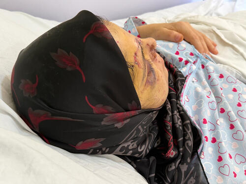 Close-up of the head injuries of the nurse injured in the Israeli strike that struck Jabal Amel Hospital on 1 June.