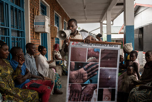 Mpox Cases Amidst Displacement Sites Near Goma