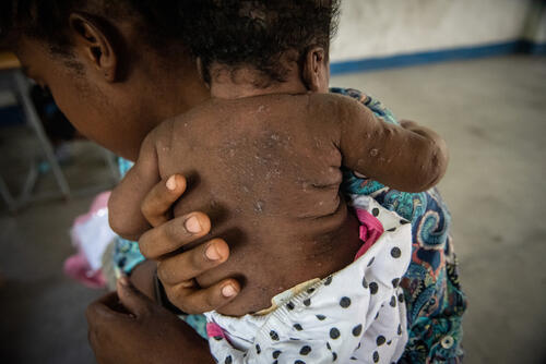 Stephanie with 1-month-old daughter who has scabies.