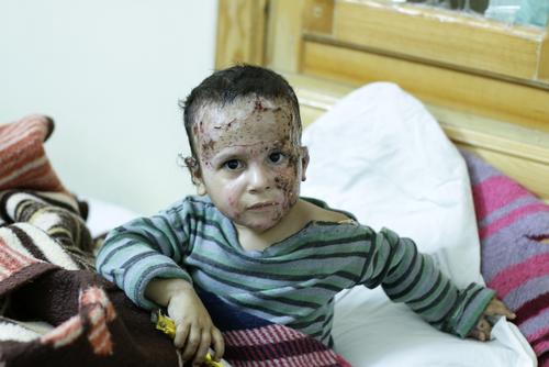 Burned children supported by MSF in northern Syria