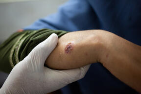 Treating cutaneous leishmaniasis in Peshawar, Pakistan