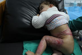 Testimonies of burn and trauma patients in Gaza
