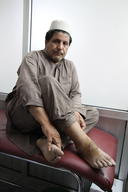 Saeepur Story  - Cutaneous Leishmaniasis Treatment, Peshawar