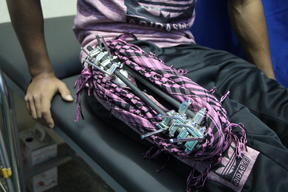 Gaza - Lifelong impact of gunshot injuries