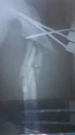 Abu Ahmed X Ray photo.jpg
