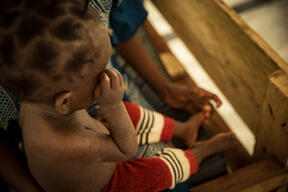 Measles in Kalole
