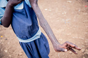 Eight-year old Jepngok Kiptui was bitten by a cobra