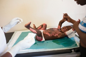 Drouillard: burnt people hospital in Haiti