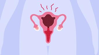What Does it Feel Like to Have an Abortion with Pills?  - French - HD