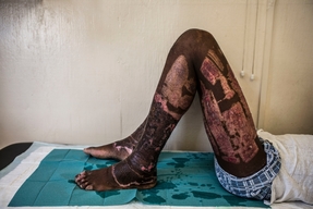 Drouillard: burnt people hospital in Haiti