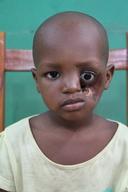 Nigeria: MSF transforms the faces and lives of those who suffer from Noma