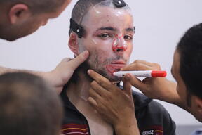 Essayage d’un masque  de compression sur un patient brûlé au visage à Gaza.
