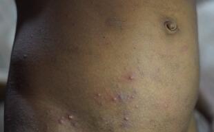 Scabies in Cox’s Bazar