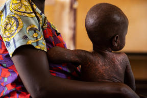 MSF Measles Intervention Bezambe: Nina and Ornella