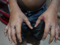 Scabies in Cox's Bazaar