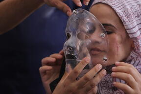 Essayage d’un masque compressif sur une patiente brûlée au visage à Gaza.