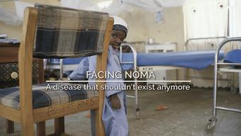 DOCUMENTARY SHORT: FACING NOMA